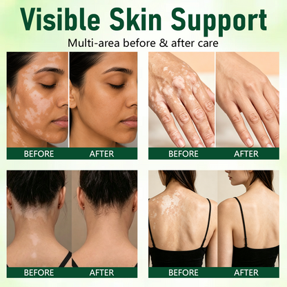 Ceoerty® Herbal Vitiligo Cream